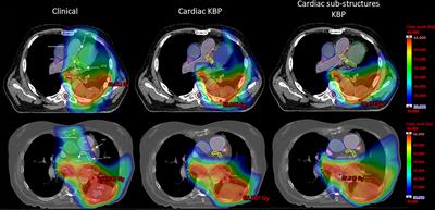 Enhanced cardiac substructure sparing through knowledge-based treatment planning for non-small cell lung cancer radiotherapy